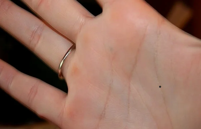 phụ nữ có nốt ruồi ở đường sinh đạo có ý nghĩa gì