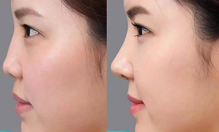 Mewing là gì? Hướng dẫn tập Mewing cho đúng phương pháp