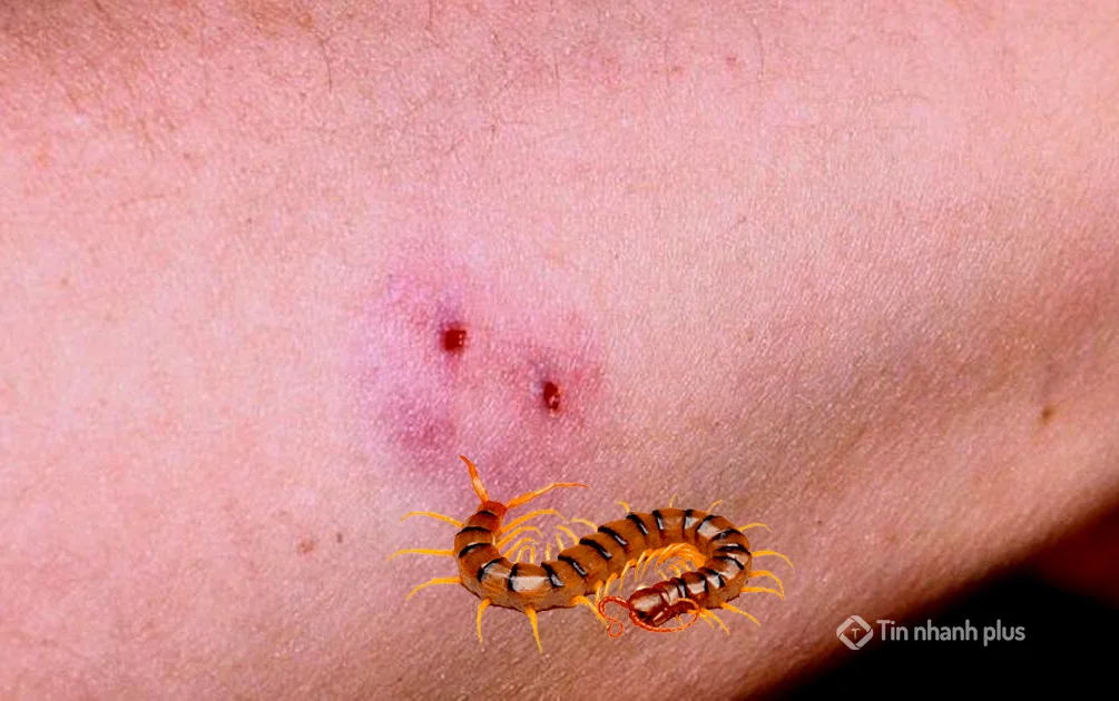 hình ảnh bị con rết cắn